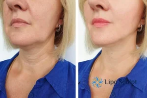 Double chin before and after Hi-Fu treatment 4 Book your double chin treatment Olney today! We are here to help!