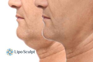 Double chin before and after Hi-Fu treatment 2 Double chin treatment Olney from Lipo Sculpt - feel more confident today!