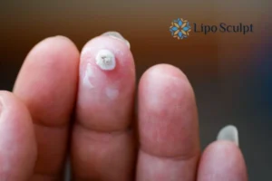 Cryopen Top 5 Treatable Conditions 4 Do you have a persistent wart of verruca that you cannot shit? Cryopen Olney treatment will work call us NOW!