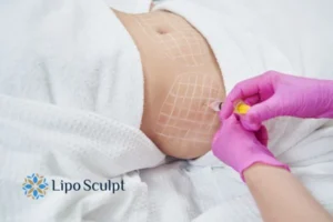 Are The Results From Aqualyx Permanent? 1 Do you want to know how long Aqualyx Olney results last?