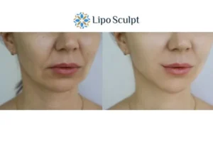 Explaining Morpheus8 And What It Can Do For You 2 Do you want to boost your self confidence? Give Morpheus8 Olney a try today!
