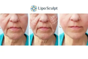 Explaining Morpheus8 And What It Can Do For You 3 Boost your confidence with Morpheus8 Olney call our team today!
